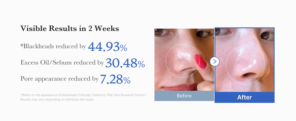 Visible results in two weeks: blackheads, excess oil and pore appearance reduced, before and after