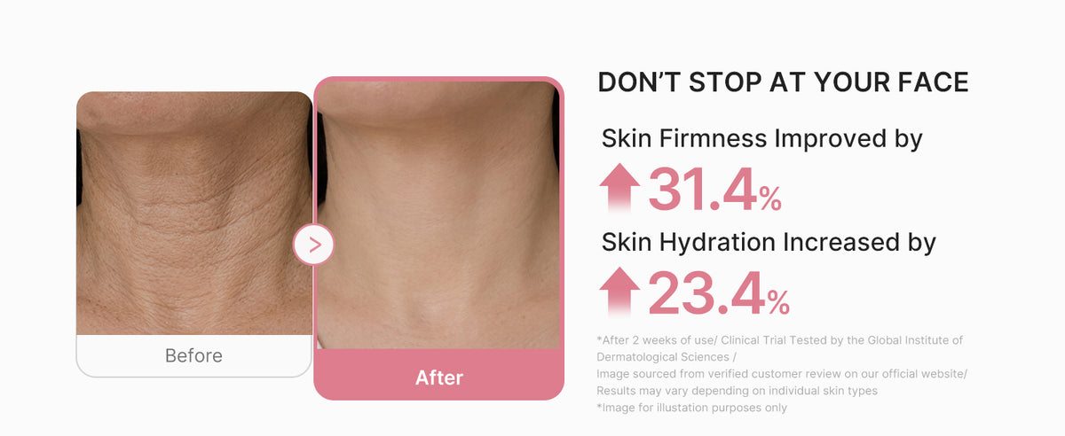 Don't stop at your face: before and after on the neck