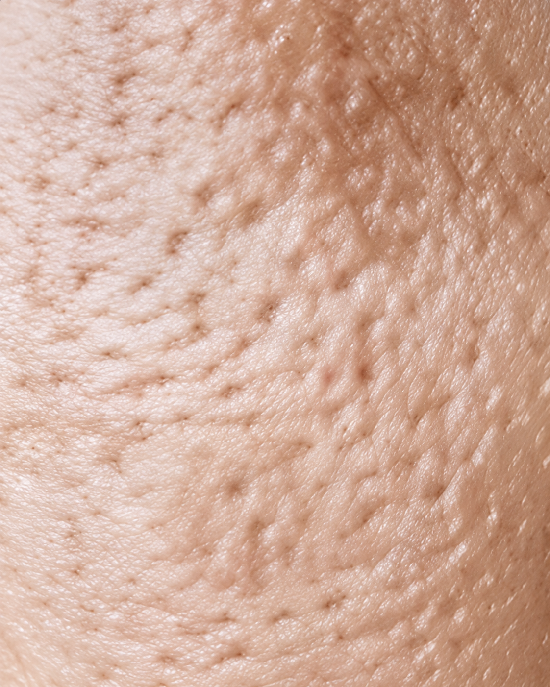 Close-up of enlarged, sagging pores